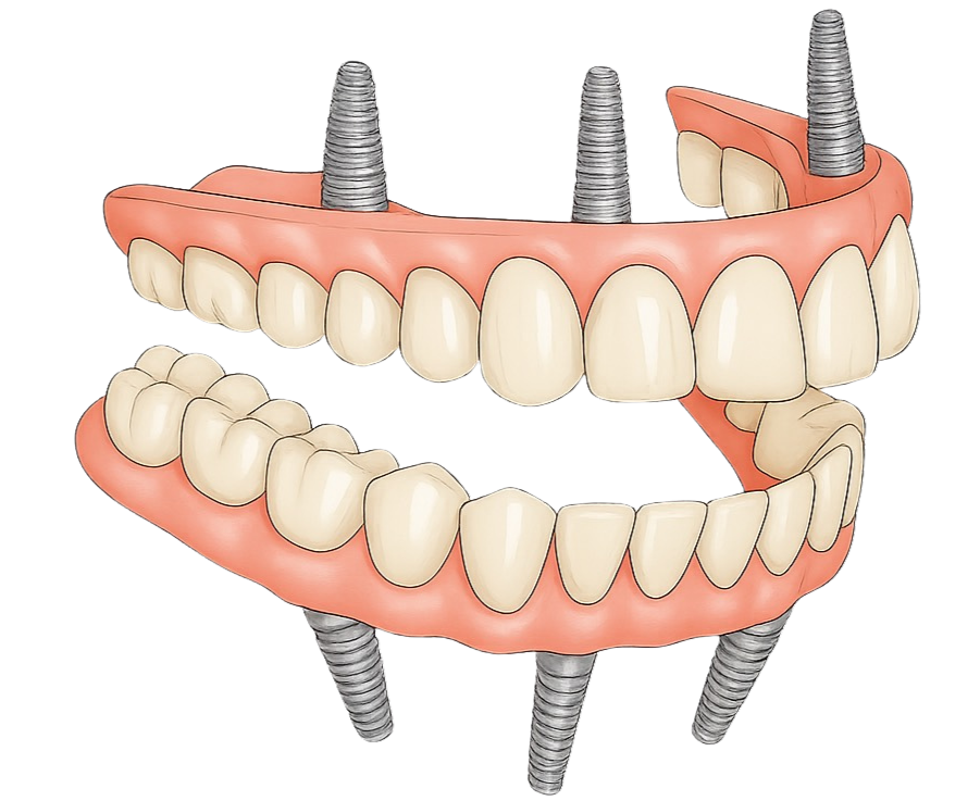 AllDentists All on 4